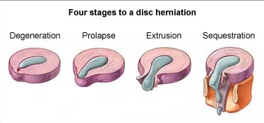 Four stages to a disc herniation